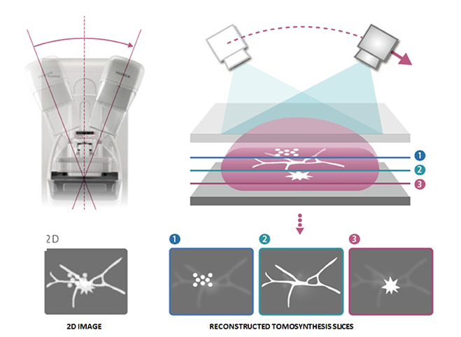 tomosynthese